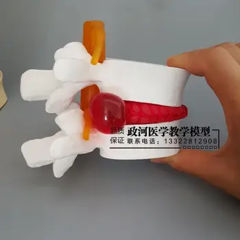 

Medical human lumbar disc disease presentation model Orthopedic spine model