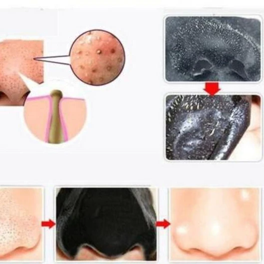 Deep Cleansing Blackhead Removing Skin Purifying Face Peel (1)