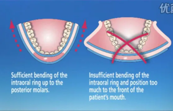 100 шт одноразовые стоматологические резиновые плотины щек втягивающие резиновый барьер стерильный контроль уход за полостью рта Отбеливание зубов