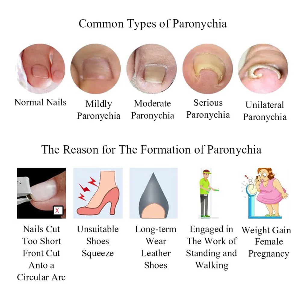 Инструмент для коррекции вросших ногтей для ногтей, инструмент для коррекции вросших ногтей, клей для ногтей, инструмент для выпрямления ногтей, фиксатор для восстановления педикюра, уход за ногами