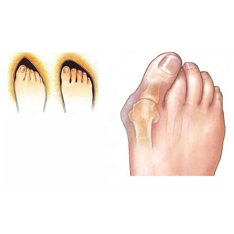 2 пары силиконовых разделителей для большого пальца ноги, корректор вальгусной деформации большого пальца, педикюр, разделители пальцев