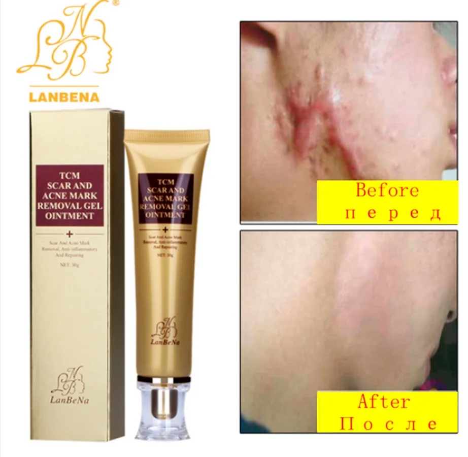 2017 New Style LANBENA Acne Scar Removal Cream Skin Repair Face Cream Acne Treatment Blackhead Whitening Cream Stretch Marks 30m f