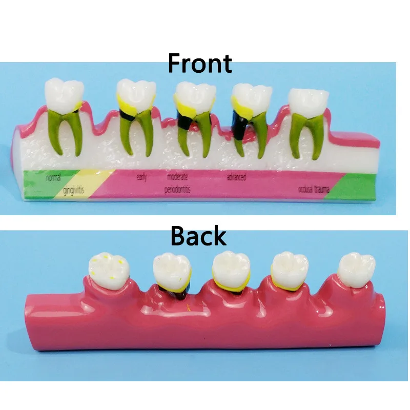 Зубные кариес модель обучение распад зубов Модель уход за зубами зубная модель для обучения зубной лаборатории модель зубного материала