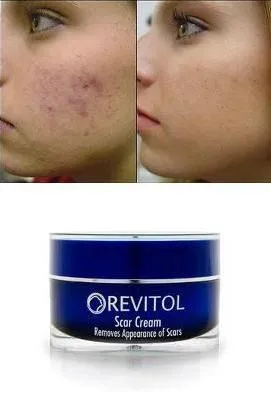 cream that can remove scars