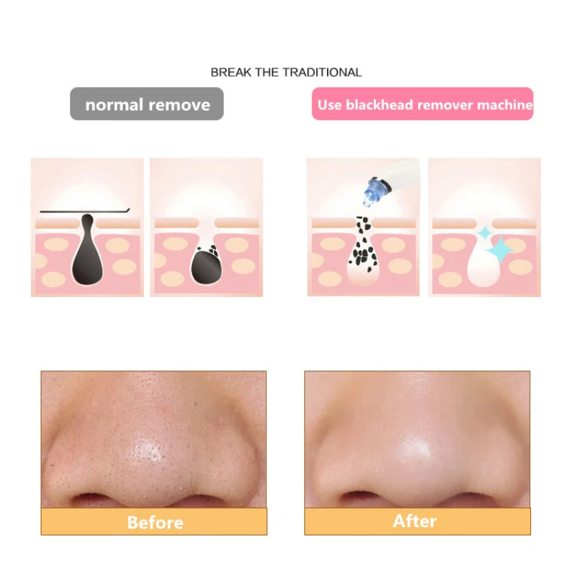 Blackhead вакуумный артефакт электрический маленький пузыристый очиститель всасывание удаление акне Клещи инструмент Лопата поры кожи прибор для лица