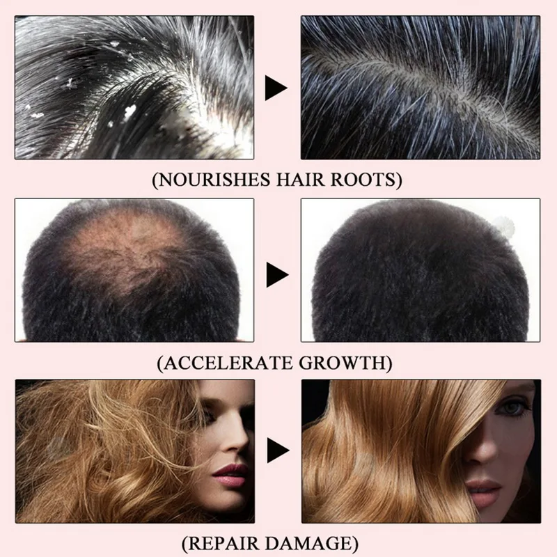 Meiyanqiong 5 шт. средство для роста волос выпадение волос жидкость анти предупреждающий потерю волос алопеция поврежденные волосы ремонт растут быстрее