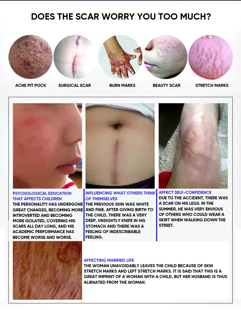 Экстракт лаванды, растяжки и удаление шрамов, растяжки, крем для восстановления кожи тела, уход за шрамами после родов