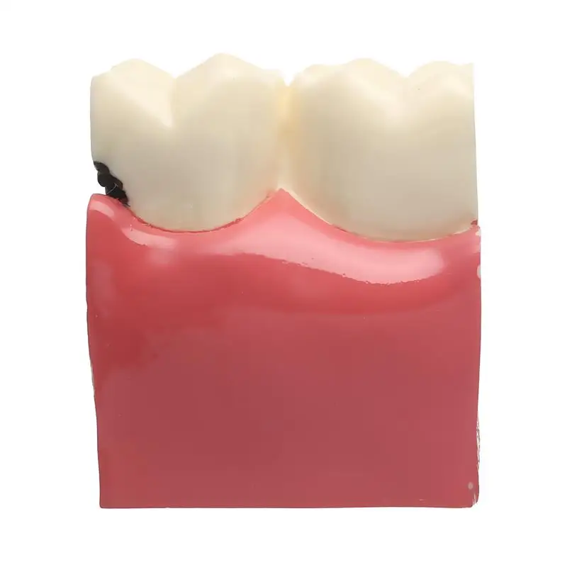 6X протеза модель кариеса сравнительная модель кариеса модель Стоматолог патологий для медицинские товары стоматологических заболев
