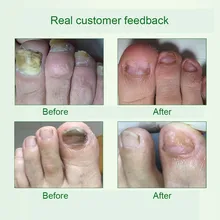 4 мл средство для лечения грибков ногтей жидкое удаление онихомикоза против грибка для ухода за ногами 669