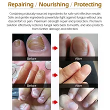 Ремонт ногтей Лечение онихомикоза ногтей эссенция против грибка Питательный Уход за ногтями 789