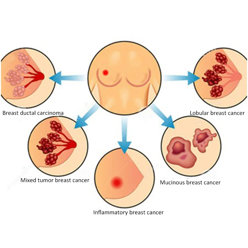 20 шт. пластырь для облегчения боли в груди, пластырь для ухода за женской грудью, пластырь для мастита, китайские травяные Пластыри для лечения припухлости, гиперплазии