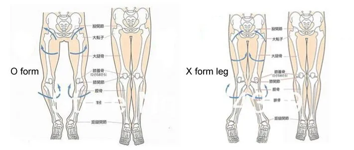 O/X стиль лечение ног-Красота ног эластичная лента для ног Коррекция системы длинные ноги очаровательный пояс без outter box
