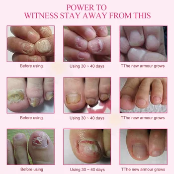 

Hot Nail Foot Protector Skin Care Cream Nail Fungus Treatment Herb Nails Repair Cream wyt77