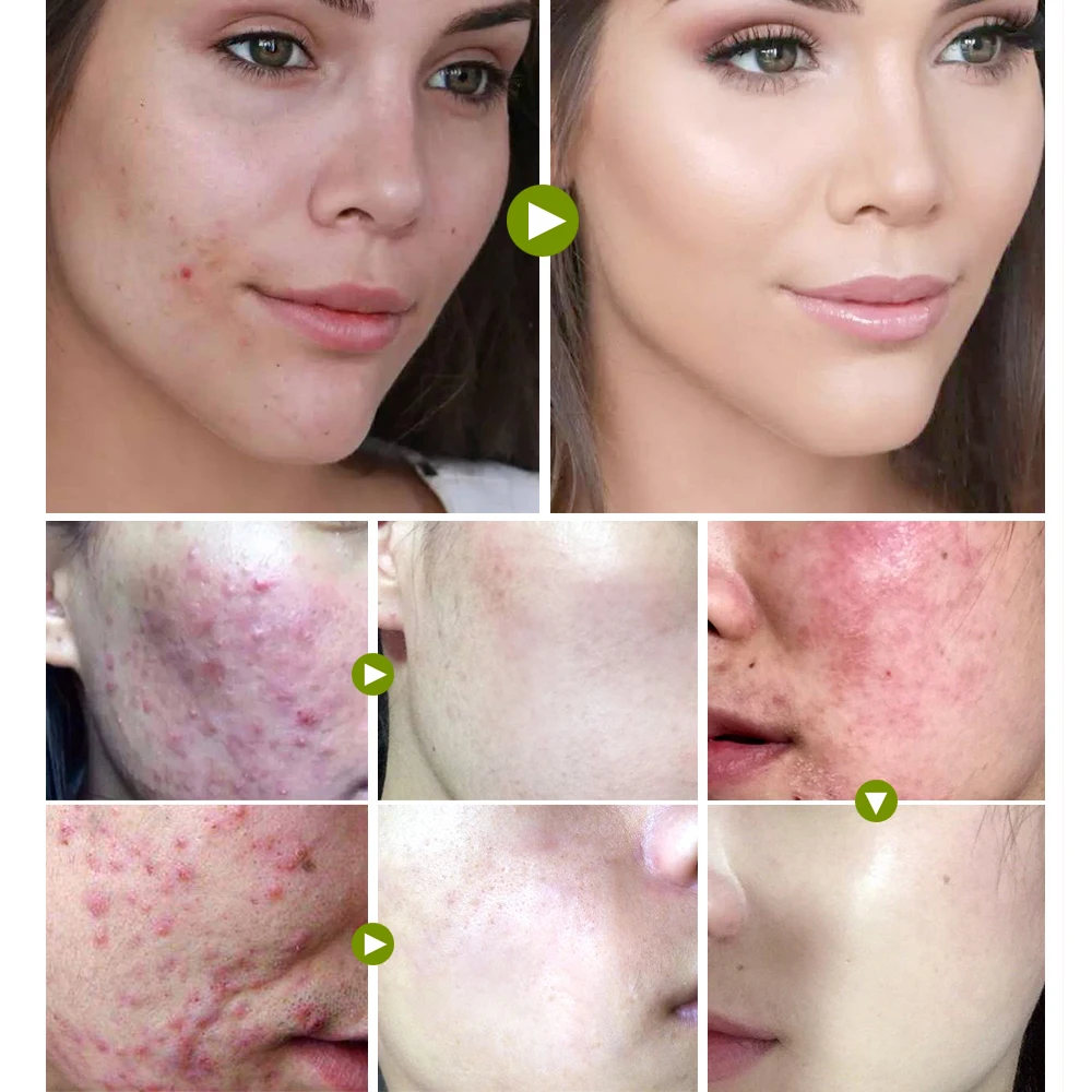 VIBRANT GLAMOUR Tea Tree Acne Face Cream Treatment Acne Scar Shrink Pores Oil Control Facial Skin Care Whitening Moisturizing