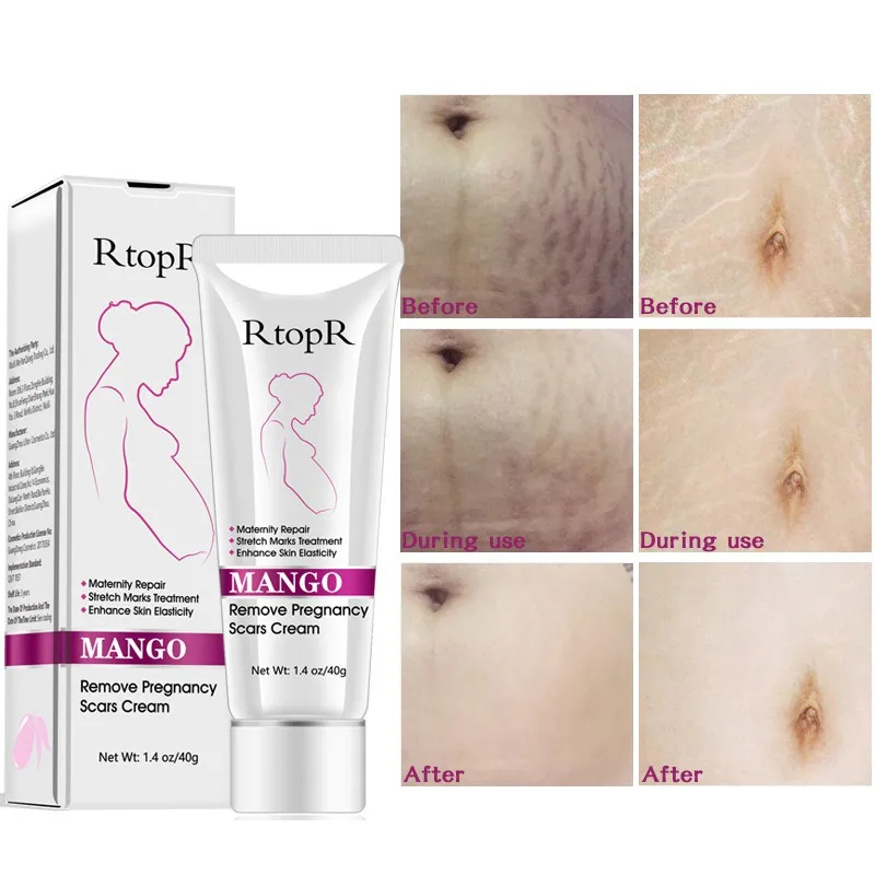 

Natural Mild Non-irritating Mango Stretch Mark Cream For Pregnancy Repair Scar Slack Line Stretch Marks Cream