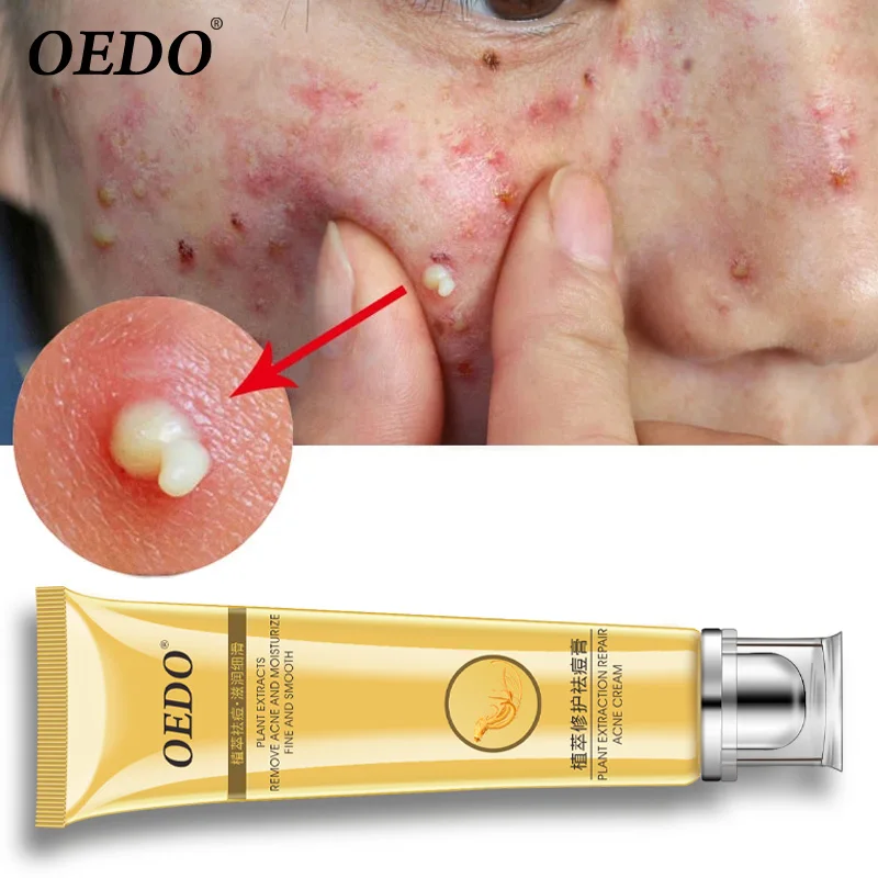 Herbal plant extract repair cream remove acne marks repair rough pores deep cleansing facial horny facial skin care cream 20g