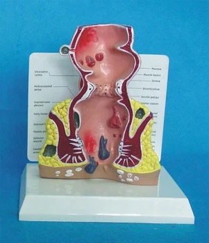 

Rectal Lesion Enlargement Pathological Rectal Model Diseased Rectal Model
