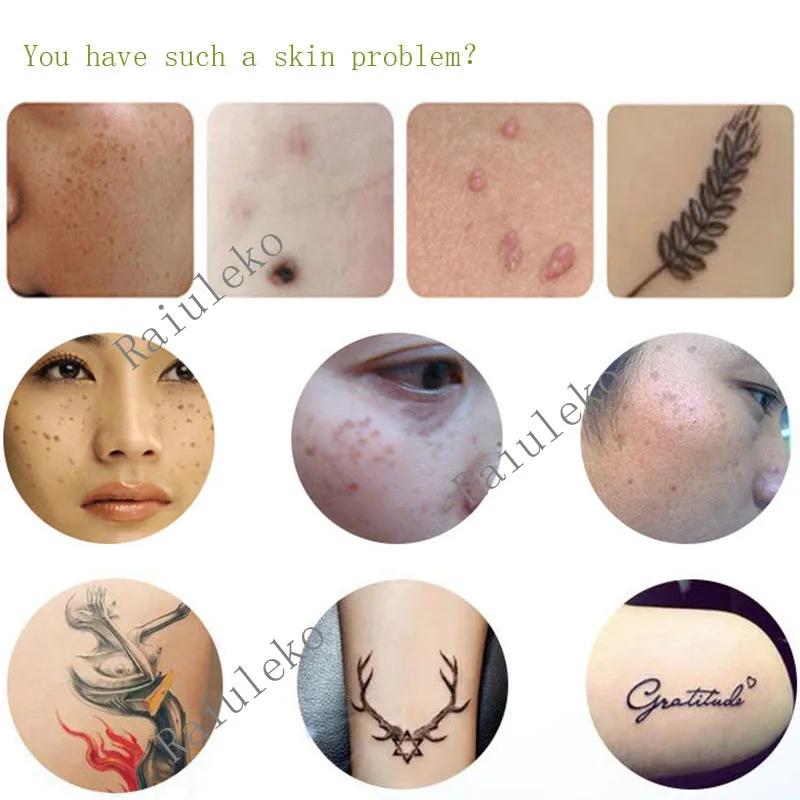 “ Remoção de Manchas Laser Tatuagem Facial Freckle Remoção
