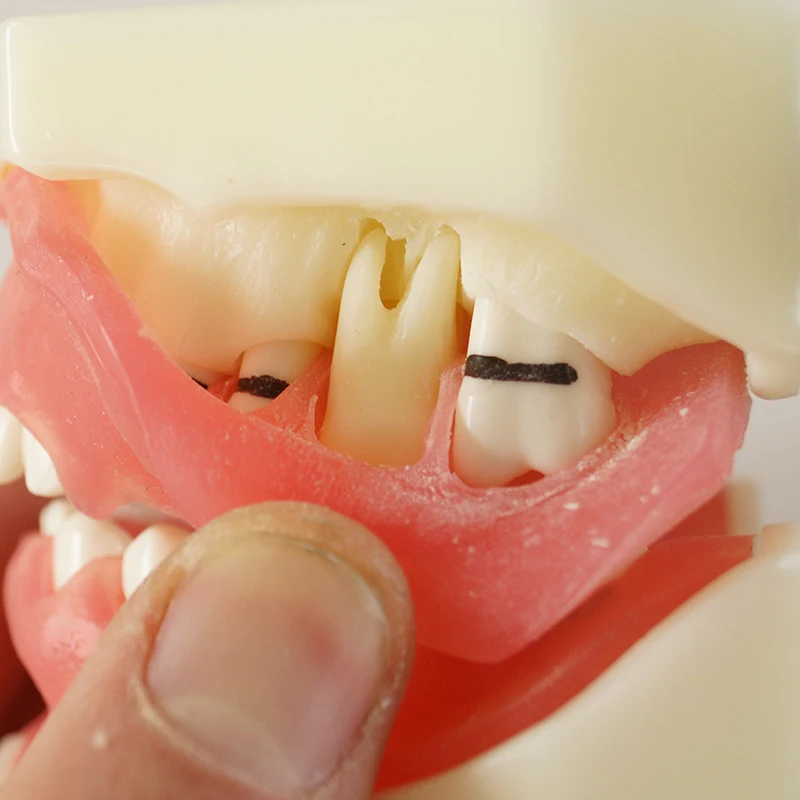 

1set Medical Science Teaching Dental Implant Disease Peridontal Disease Model