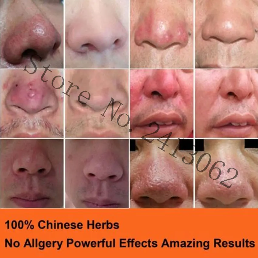 パールにきびクリーム赤い鼻軟膏にきび削除にきびクリームスキンケアハーブ抗にきびダニにきび酒御馳走シュリンク毛穴 エッセンシャルオイル Aliexpress