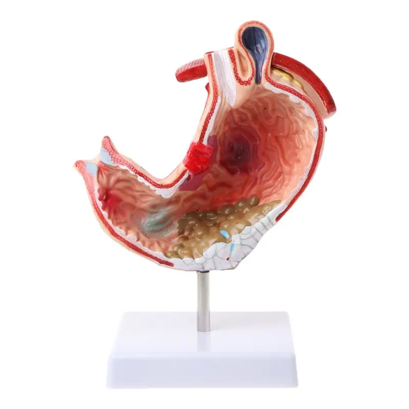 

Human Anatomical Anatomy Stomach Model Gastric Pathology Gastritis Ulcer Teaching Learning Tool