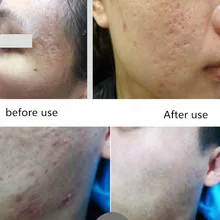 Pock pit and ance Крем для ремонта шрамов