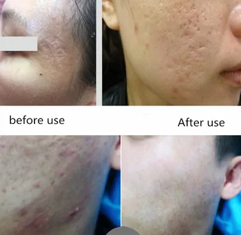 

pock pit and ance scar repair cream profession sit