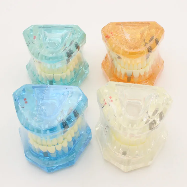

1pcs Dental Model teeth implant Restoration Bridge Teaching Study Tooth Medical Science Disease Study Dentist Dentistry products