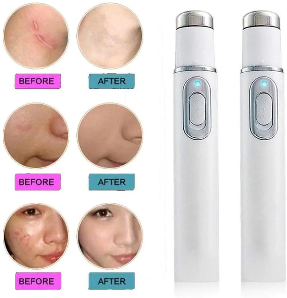 Blue Light Therapy Varicose Veins Treatment Laser Pen Soft Scar Wrinkle Removal Treatment Acne Laser Pen Massage Relax blue light therapy pen laser pen therapy