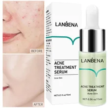 

Face Serum Remove Acne Fades Acne Marks Moisturizing Brighten Skin Colour Nourish Anti-Aging Improve Skin Condition Repair Face