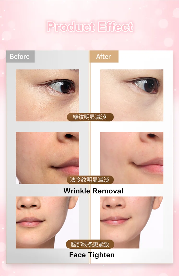 5 in 1 ems rf ems massage facial galvanic mesotherapy electroporation rf home beauty device for face