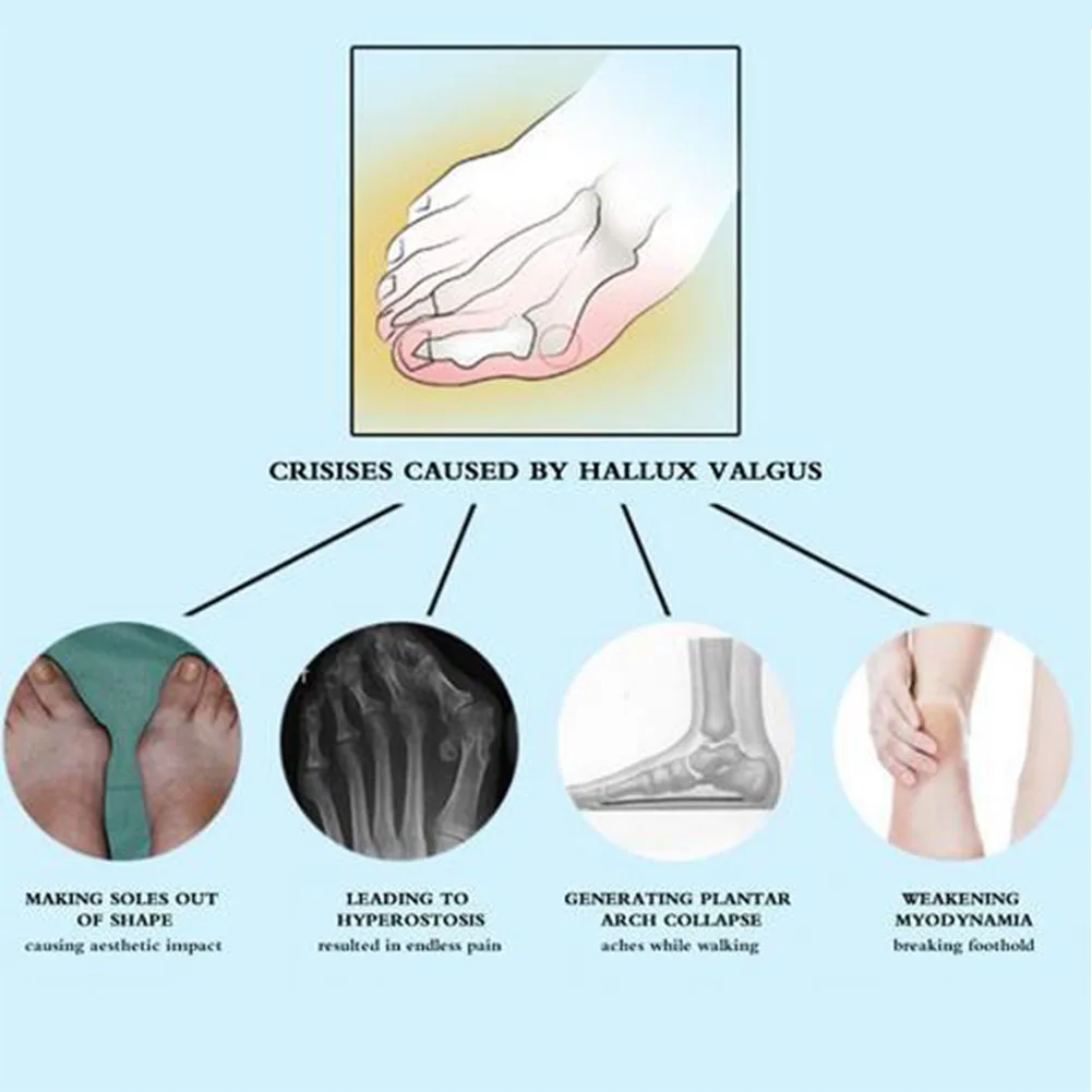 Pain Relief Foot Care Corrector Belt Correction Tool Bunion Splint Straightener Hallux Valgus Big Toe Foot Corrector Adjustable