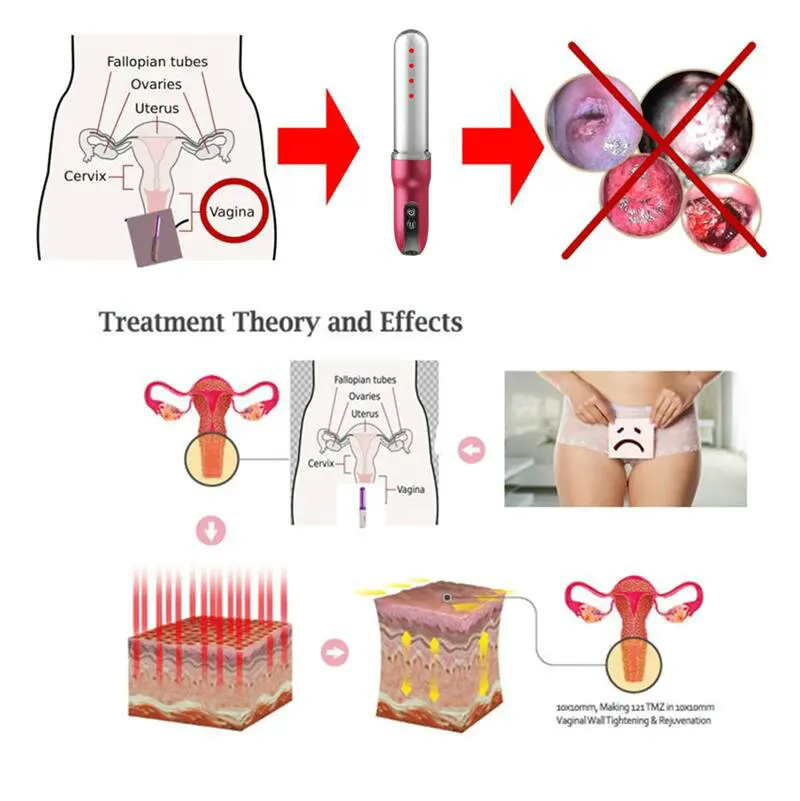 Cervicitis лечение вагинальное затягивание Домашние средства холодная лазерная терапия устройство