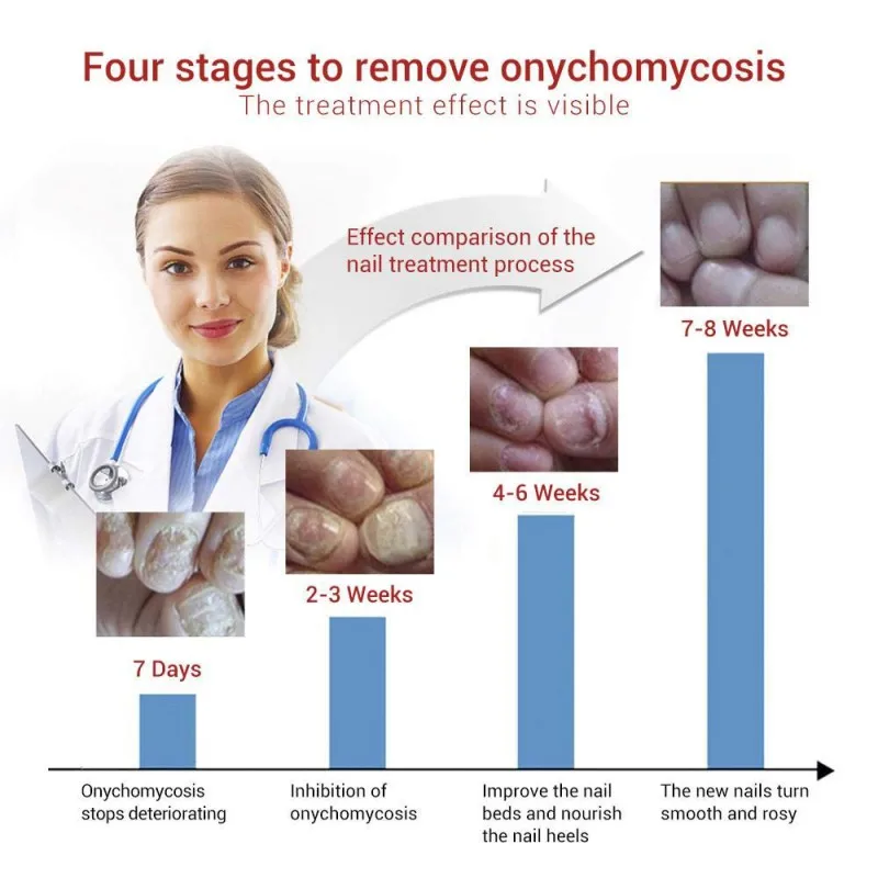 Яркий грибковый гвоздь onychomicosis эссенция для удаления ухода за ногами анти-инфекционный Уход за ногтями на ногах