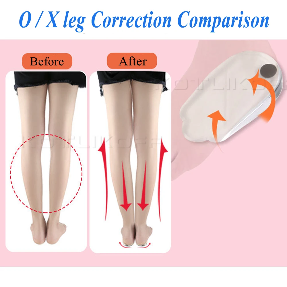 Shoe Insoles Magnetic Massage Gel O/X Type Leg Orthotics Heel Pads Corrective Valgus Varus Foot Insert Pads