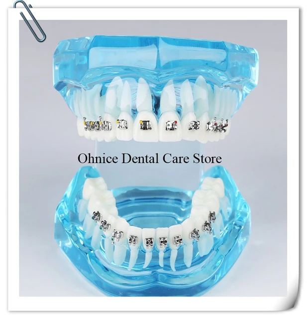 Crochet Dentaire - Appareils Orthodontiques - AliExpress