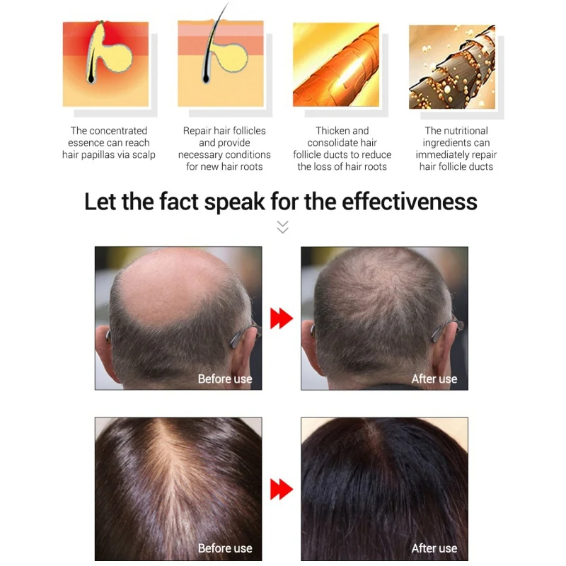 Имбирный раствор для роста волос питает кожу головы анти вилка средство