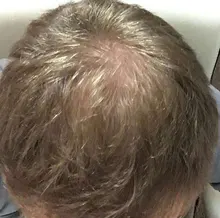 Cuidado del cabello para el crecimiento del cabello aceites esenciales esencia Original auténtico 100% pérdida de cabello líquido salud belleza suero denso para el crecimiento del cabello