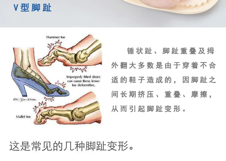 Коррекция носка Pad вальгусная деформация перекрытие пальцев ног разделитель пальцев ног молоток