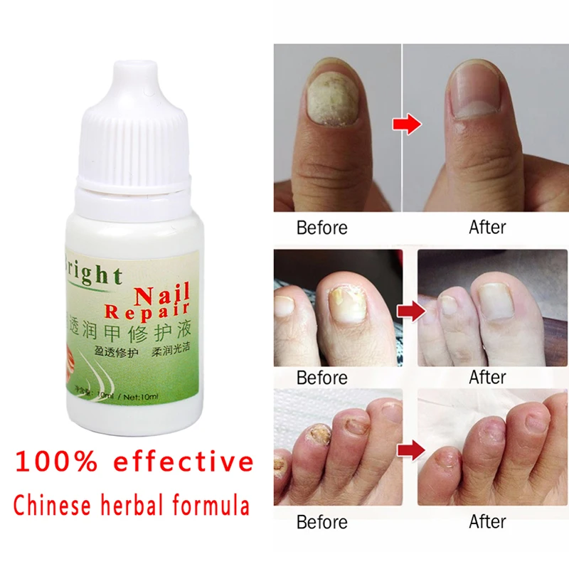 10 мл травяной Антибактериальный раствор для ногтей Лечение онихомикоза стерилизация для удаления грибка для ногтей