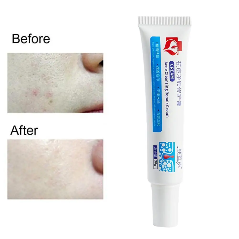 

Herbal Medicine Acne Treatment Face Cream Blackhead Gel Oil Safe Care Shrink Cream Control Gentle Pores Scar Acne Skin Repa X9L0