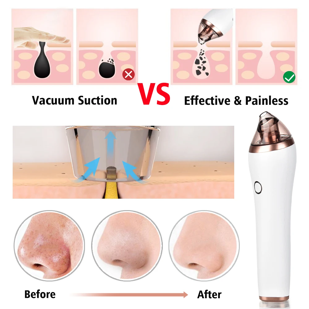 Electric Blackhead Remover Machine Facial Pore Vacuum Cleaner Acne Pimple Suction Extractor 4 in 1 Body.jpg