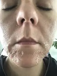 2ml Tca Peel Skin Peel Kit 35 Removes Tattoos Age Spots Scars Stretch Marks 2 Free Shipping Skin Peel Tca Peelstretch Marks Aliexpress