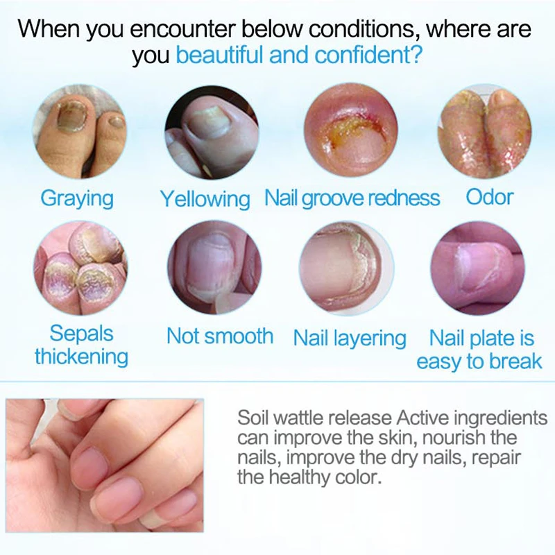 Nail Repair Liquid Herbal Care Treatment With File Foot Nail Anti Remove Nail Onychomycosis Fungus Toe 3