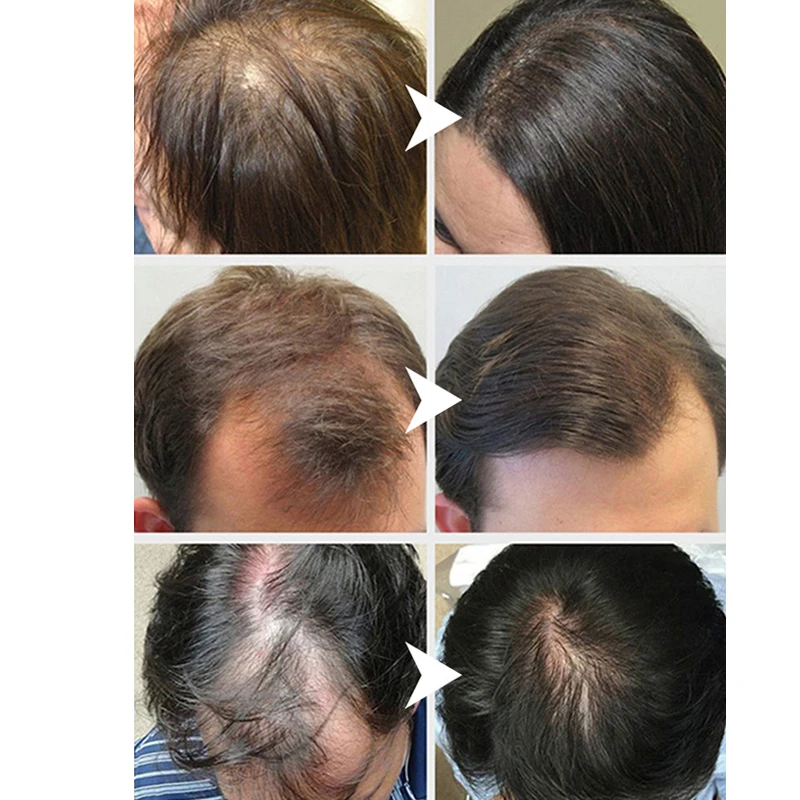 Hair Growth Serum Repair Damaged Hair Follicles Anti-hair Loss Anti-fork  Withered Deep Nourishment Anti-dandruff Anti-itch Mild - Hair & Scalp  Treatments - AliExpress
