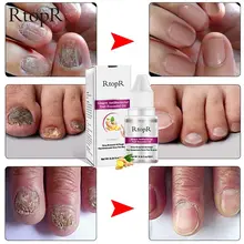 RtopR имбирь антибактериальные уход за ногтями онихомикоз паронихии анти-грибковая ногтей инфекции носок Лечение грибка 10 мл U90F