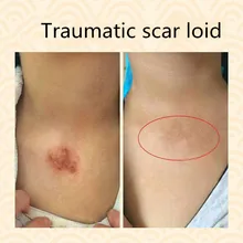 Удаление шрамов и восстанавливающая комбинация жидкости, ожоги/ожоги, лазерные хирургии, вогнутые/Выпуклые шрамы и келоидные, травматические
