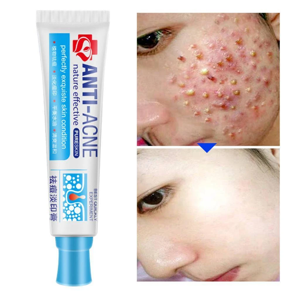pimple marks reducing cream