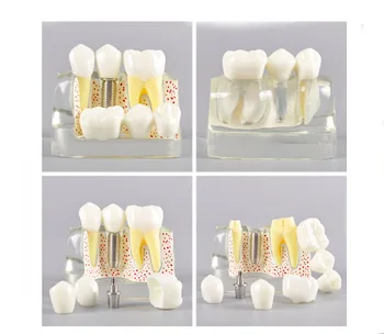 

Dental Model Implant Model Analysis Crown Bridge Demonstration 1pc