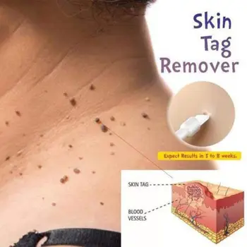 

10ml Skin Tag Remover Anti Verruca Remedy Mole Remover Wart Remover Effective Body Skin Care Removal Foot Corn Remover